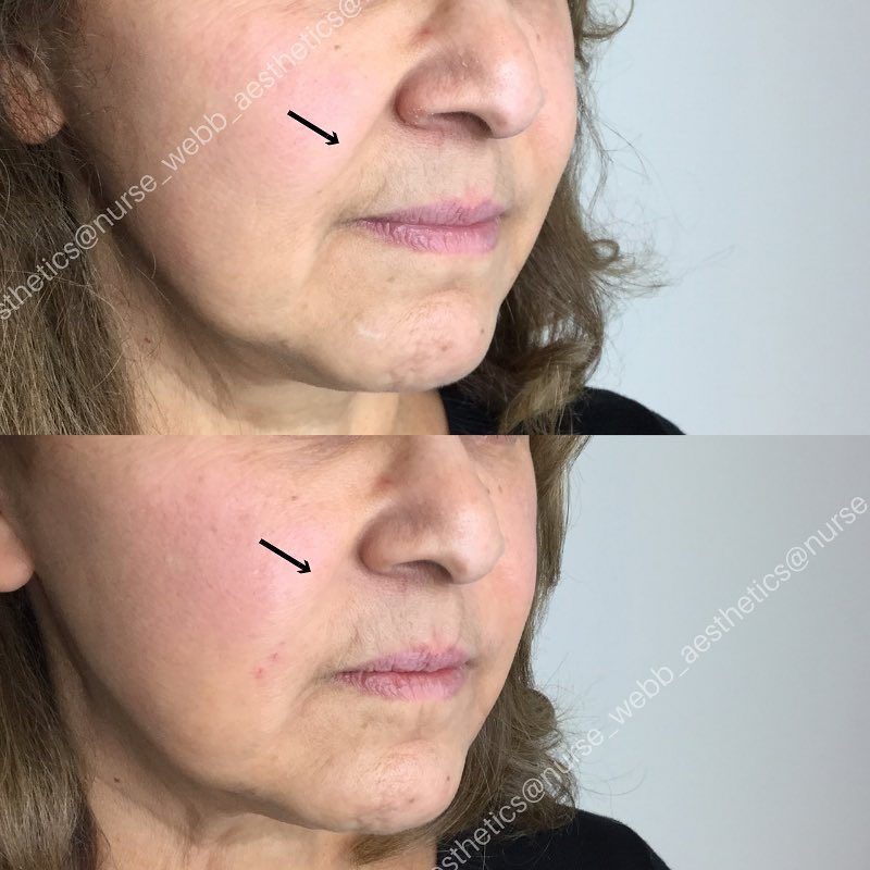 Laugh Line Augmentations in Houston Texas | Medical Spa