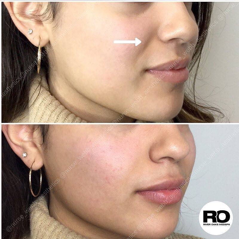 Laugh Line Augmentations in Houston Texas | Medical Spa