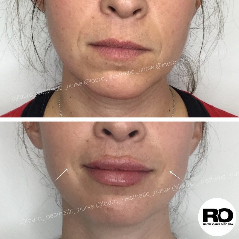 Laugh Line Augmentations in Houston Texas | Medical Spa