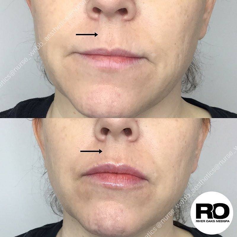 Laugh Line Augmentations in Houston Texas | Medical Spa