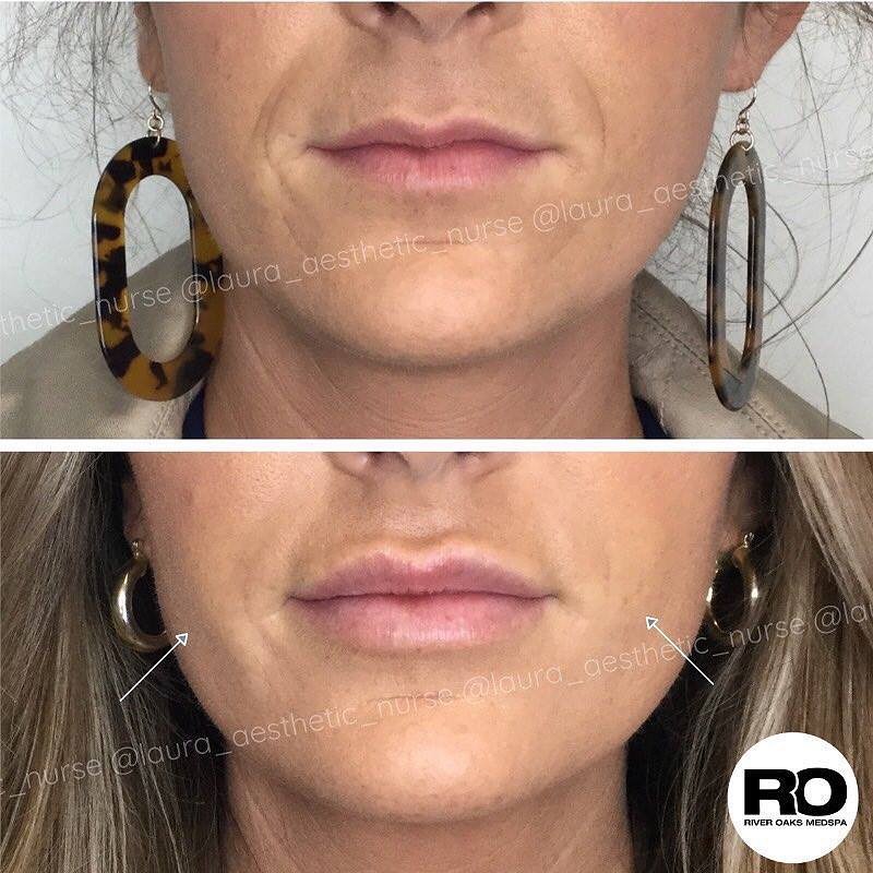Laugh Line Augmentations in Houston Texas | Medical Spa