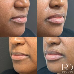 natural lips on woman showing before and after results