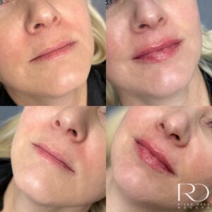 Natural lip filler done on a woman with initially very thin lips. Juvederm, Restalyne