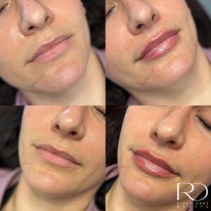 Natural lip filler using Juvederm Ultra XC on a woman