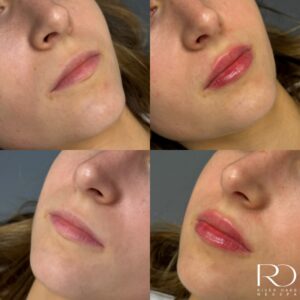 Client's before and after results after doing a lip filler appointment. Her results are great and you can see her shape is still natural and elegant.