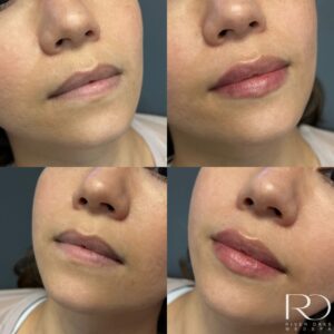 lip filler showing before and after results of beautifully filled lips.Juvederm, Restalyne